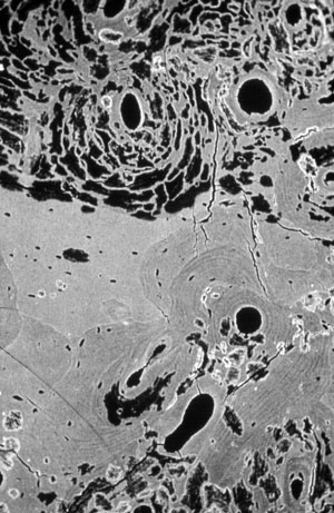 baterial remodelling